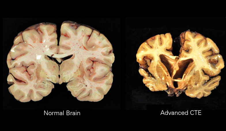 How Former NFL Players Live With Traumatic Brain Injuries 1 Traumatic Brain Injuries